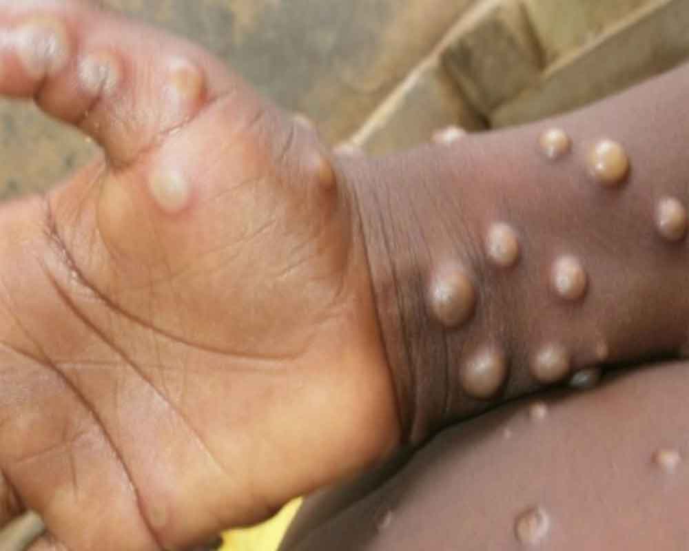 Pakistan to increase surveillance after WHO declares monkeypox as global health emergency