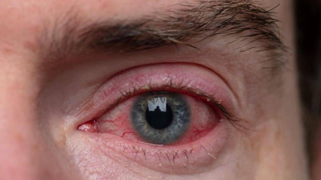 15,105 pink eye cases reported in 24 hours in Punjab