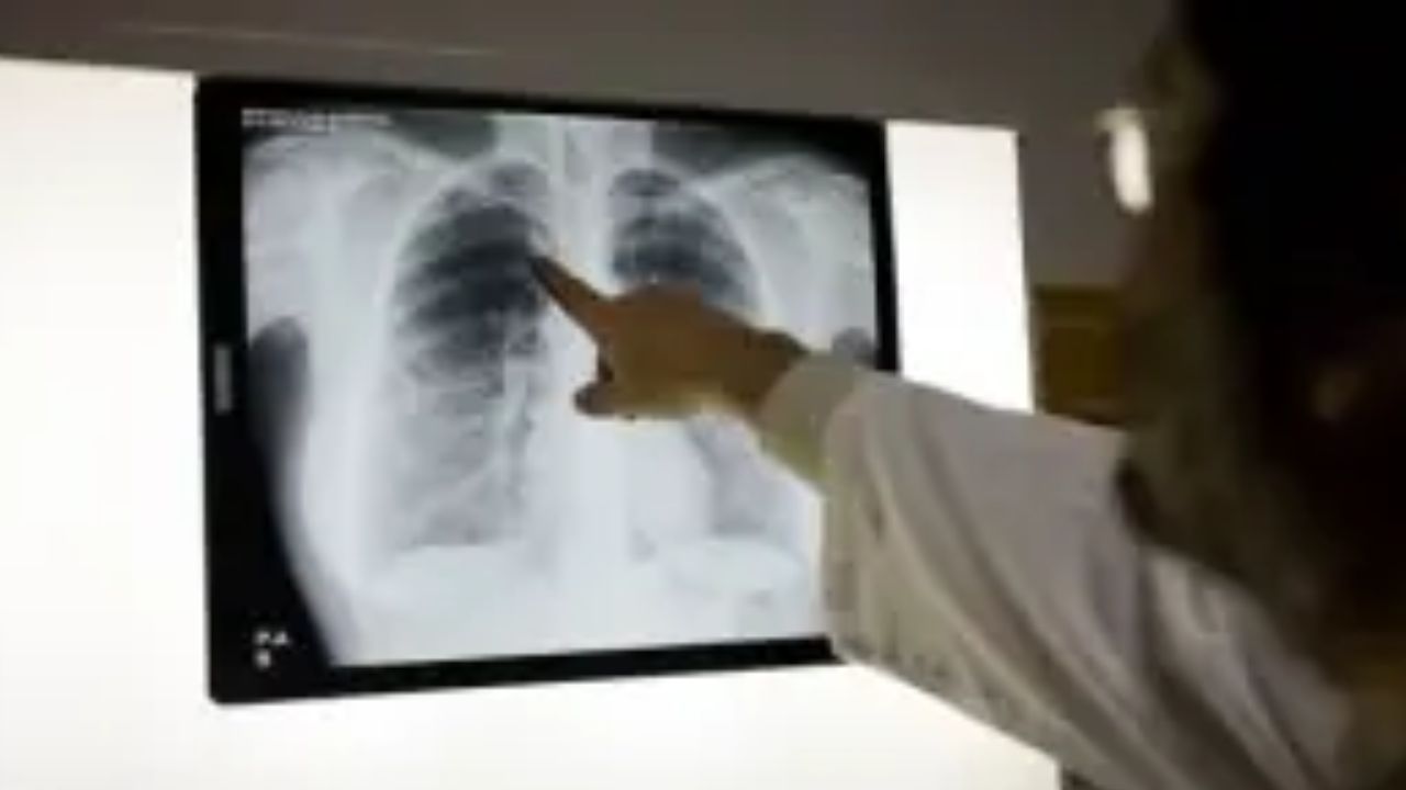 WHO says TB kills 140 people in Pakistan every day